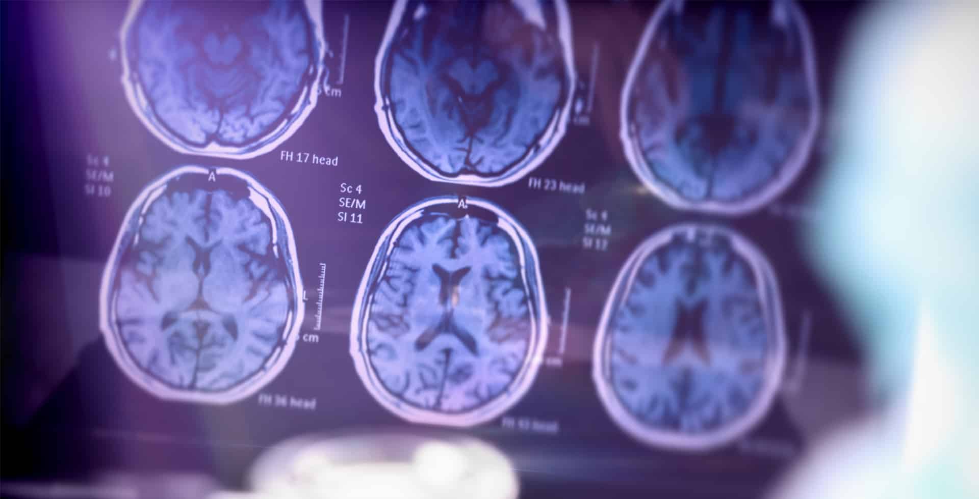 Magnetkamerabilder som visar tvärsnitt av en mänsklig hjärna.